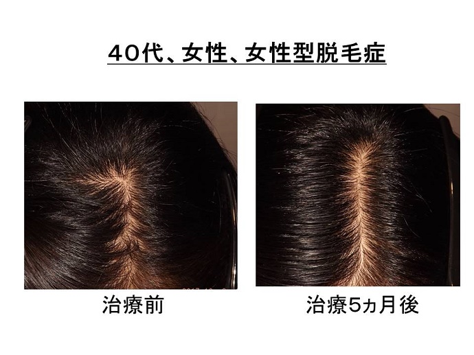 円形脱毛症　病院
